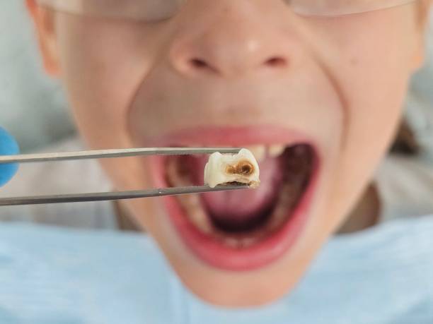 Best Emergency Treatment for Oral Infections in Pierceton, IN